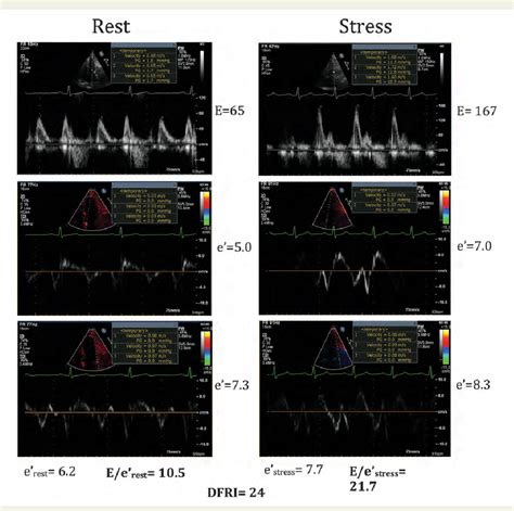 impaired diastolic stress testing